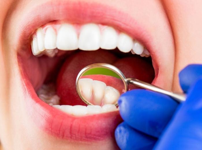 Four Benefits of Dental Cleaning