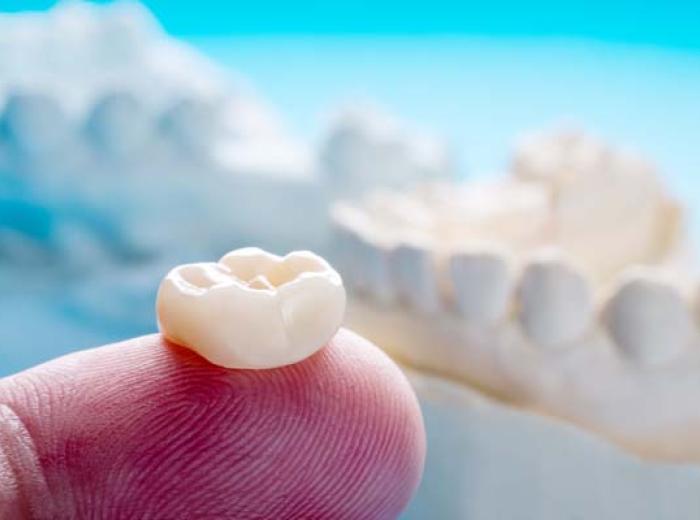 Dental Crown Procedure: How Many Appointments Needed?