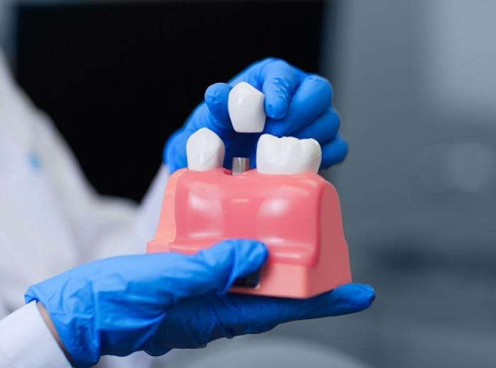 Everything You Need to Know About Dental Crowns
