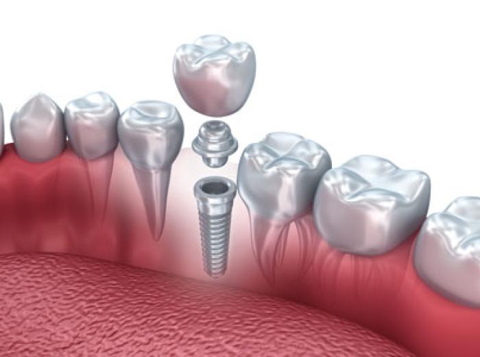 Dental Implants Care Tips from an Expert Implant Dentist