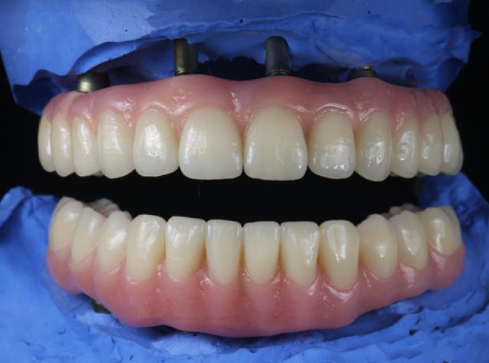 Choose Implant Supported Dentures for Better Oral Health