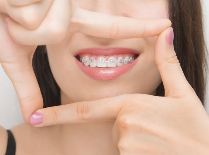 Orthodontic Treatment for Crooked Teeth