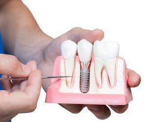 Good Candidates for Implant Dentistry