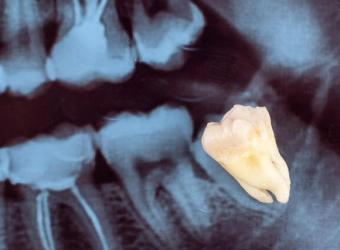 Everything You Need to Know About Wisdom Teeth Removal: Signs, Procedure, and Recovery