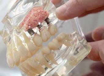 Sinus Lift Surgery: Making Dental Implants Possible