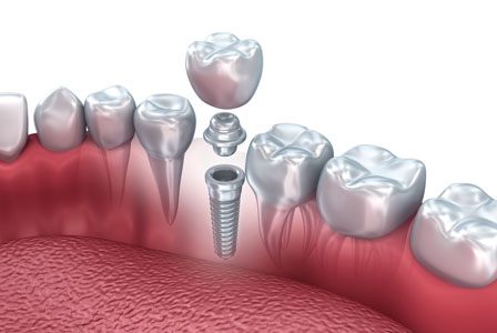 Tips For Keeping Your Implant In Good Condition From An Implant Dentist
