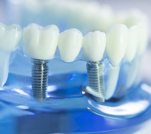 Jenkintown Dental Implants