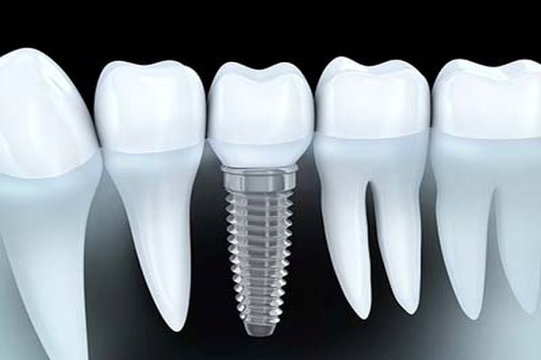 Dental Implant FAQ&#    ;s In Jenkintown