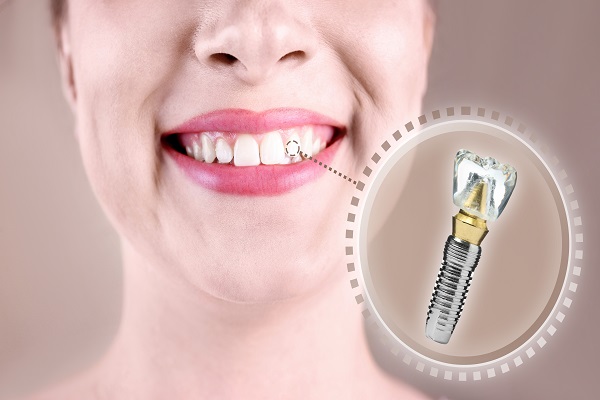 Ask An Implant Dentist: What&#    ;s The Difference Between Natural Teeth And Implants?